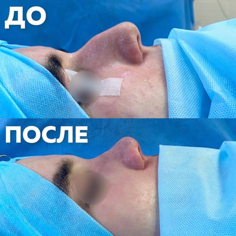 Фото до и после ринопластики в Москве у пластического хирурга Паруйра Минасяна