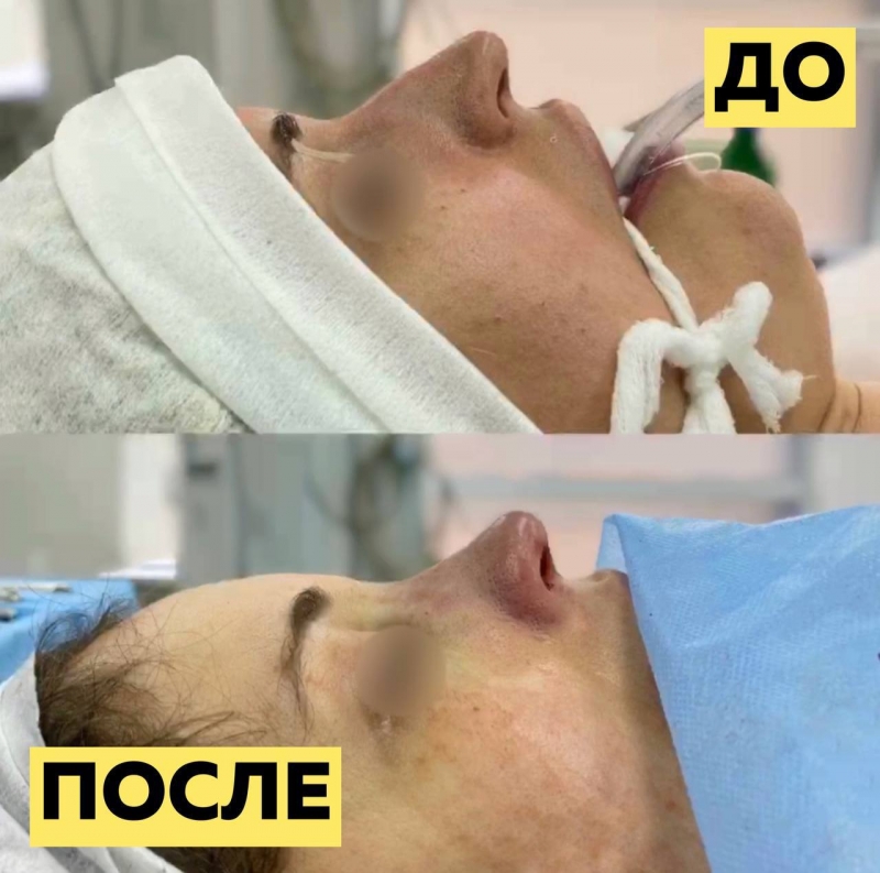 Пациентка до и после ринопластики у пластического хирурга Паруйра Минасяна