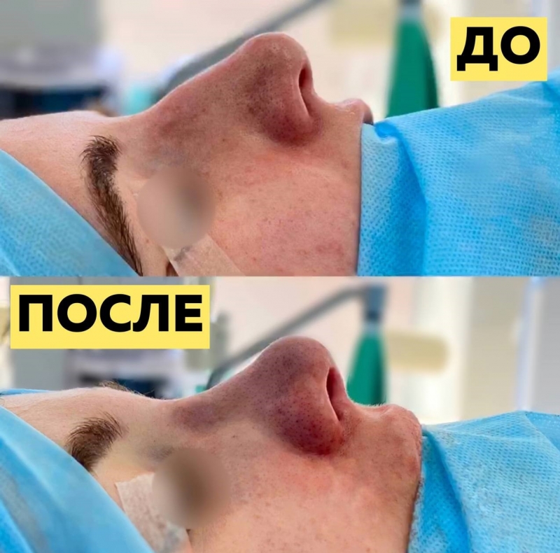 Пациентка до и после риносептопластики носа в Москве у пластического хирурга Паруйра Минасяна