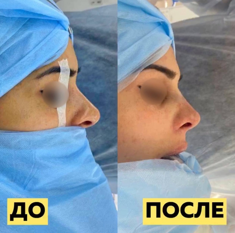 Пациентка до и после ринопластики в Москве у доктора Паруйра Минасяна