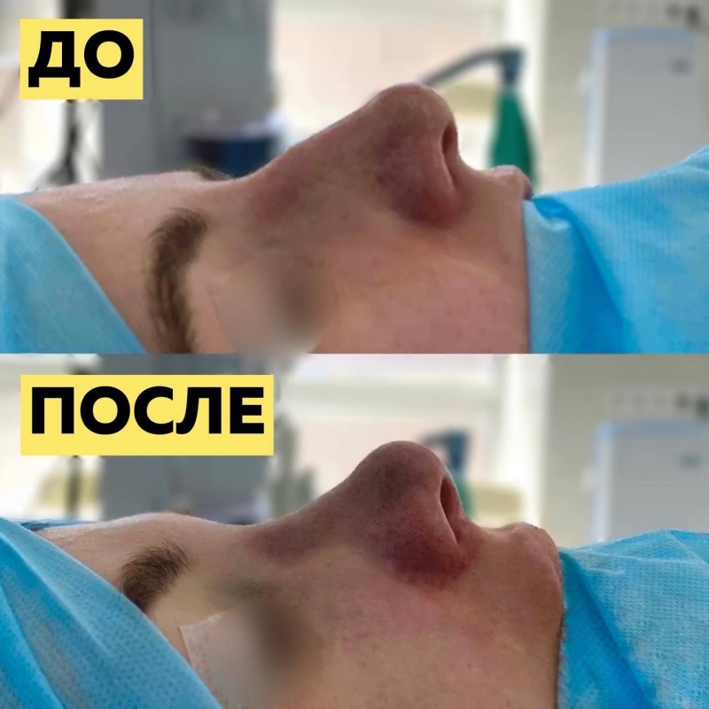 Фото пациентки до и после ринопластики в Москве у доктора Паруйра Минасяна