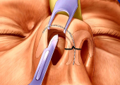 Открытая ринопластика