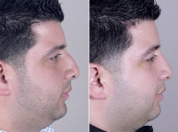 До и после закрытой ринопластики