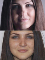 before and after operation