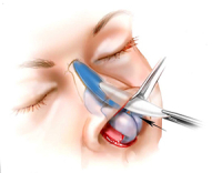 open rinoplasty