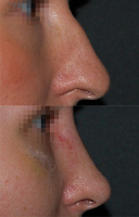 rezultat rinoplastiki