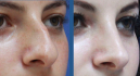 Ринопластика у Данилы Кузина