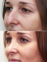 do i posle rinoplastiki