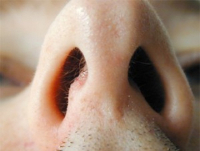 Искривление носовой перегородки