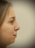 Теперь нос пациентки выглядит так