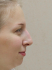 Нос пациентки, который она решила изменить