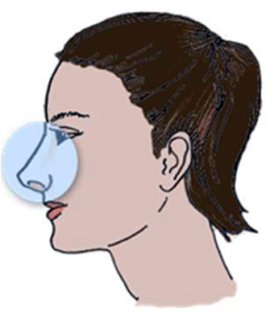 Осложнения после ринопластики