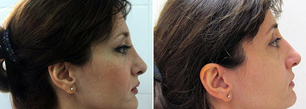 Фото до и после реконструктивной ринопластики у Александра Гуляева