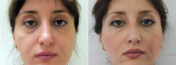 Фото до и после реконструктивной ринопластики у Александра Гуляева