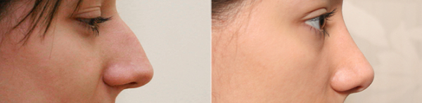 Фото до и после ринопластики у Александра Жукова