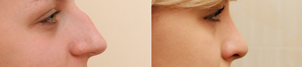 Фото до и после ринопластики у Александра Жукова