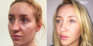 До и после ринопластики