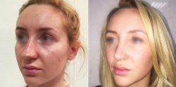 До и после ринопластики у Светланы Пшонкиной
