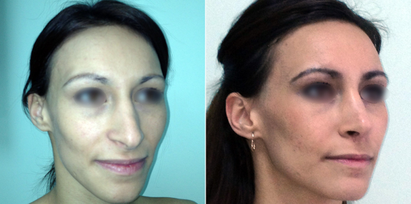 Фото до и после ринопластики у Светланы Пшонкиной