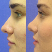 Фото до и после ринопластики у Светланы Пшонкиной