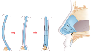 Септопластика