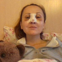 С лангеткой после ринопластики