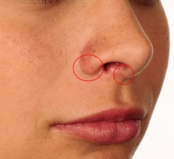 Шрамы после уменьшения ноздрей