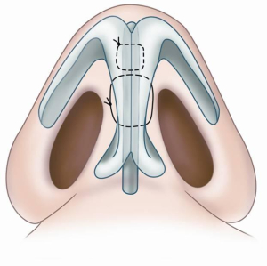 открытая ринопластика