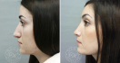 Ольга Носова. Пациентка до и после ринопластики