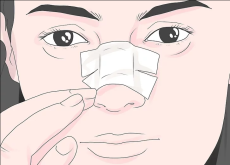 Реабилитация после ринопластики