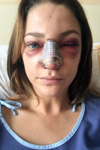 Осложнения после ринопластики