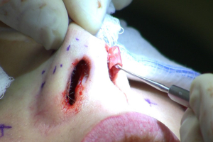 Закрытая ринопластика Пшонкина