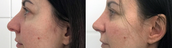 Пластика кончика носа