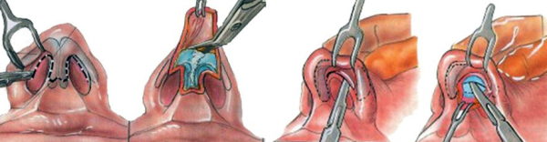 Открытая и закрытая ринопластика