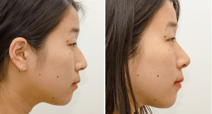 Азиатский нос до и после ринопластики