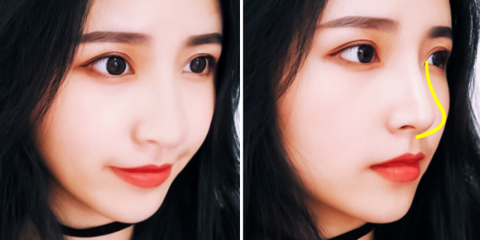 Азиатский нос ринопластика