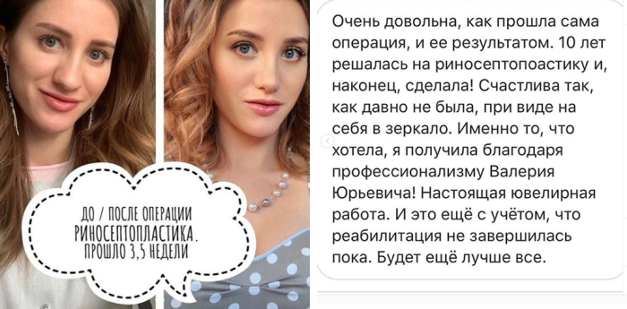 Отзыв пациентки Валерия Стайсупова после ринопластики