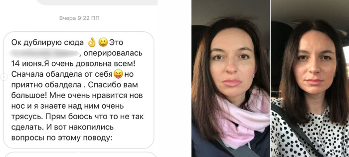 Отзыв пациентки Валерия Стайсупова после ринопластики