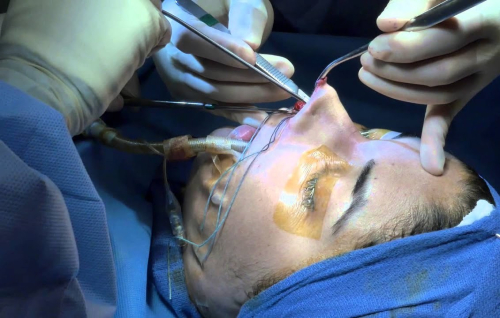 Этническая ринопластика у латиноамериканцев