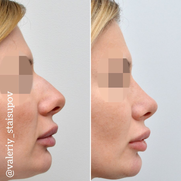 Закрытая ринопластика у доктора Стайсупова. Фото пациентки до и после