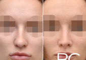 Закрытая ринопластика у пластического хирурга Валерия Стайсупова. Фото пациентки до и после.