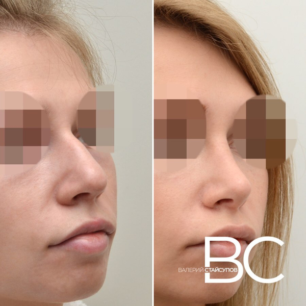 Закрытая ринопластика у доктора Стайсупова. Фото до и после