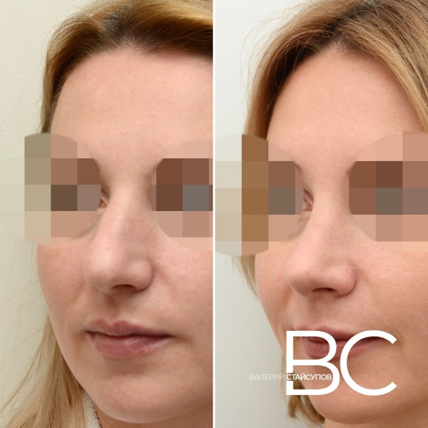 Закрытая ринопластика у доктора Валерия Стайсупова. Фото до и после
