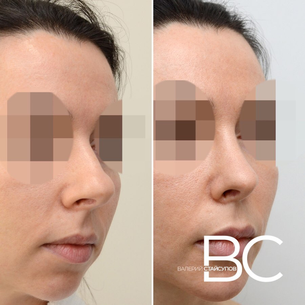 Закрытая ринопластика у доктора Стайсупова. Фото до и после.