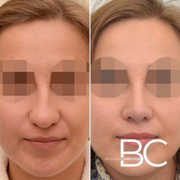 Закрытая ринопластика у доктора Стайсупова. Фото пациентки до и после.