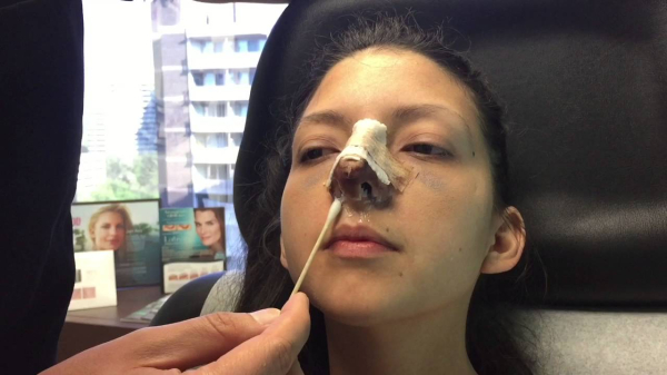 Реабилитация после ринопластики