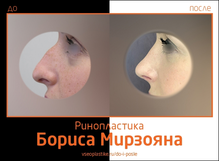 ринопластика Борис Мирзоян
