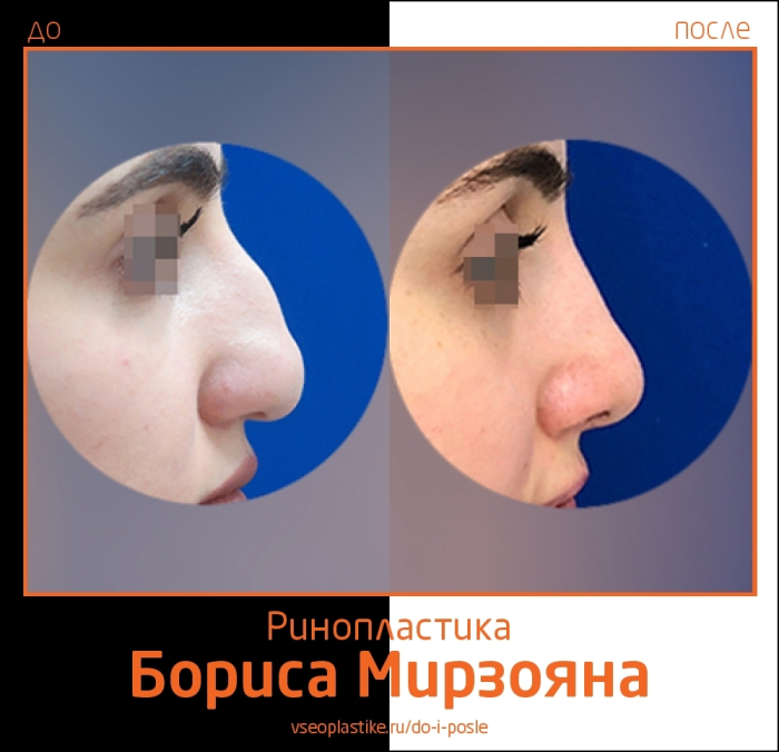 ринопластика Борис Мирзоян