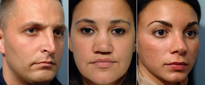 Примеры неудачной ринопластики носа