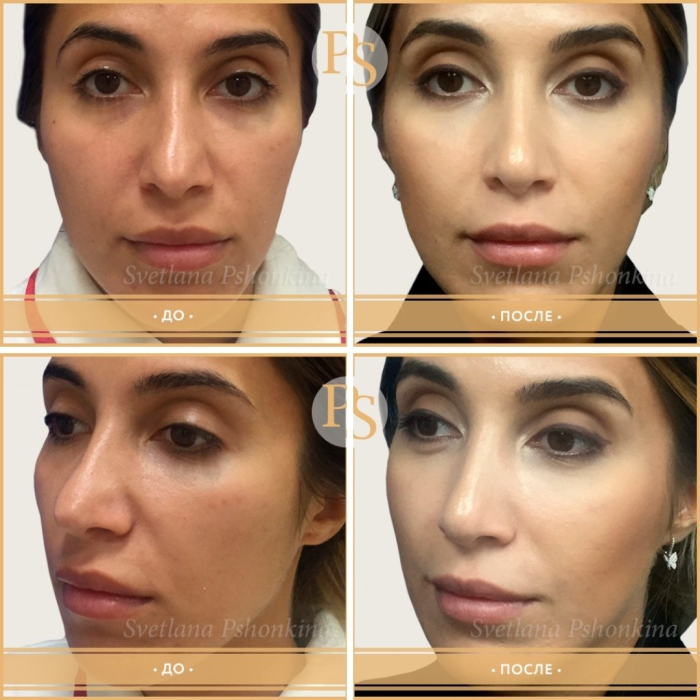 Фото до и после ринопластики у доктора Пшонкиной
